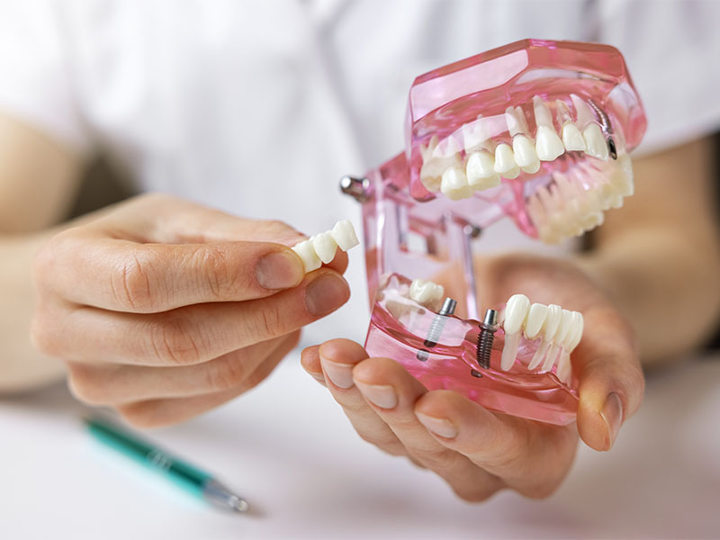 Zahnarzt in Freiburg erklärt Funktionsweise eines Zahnimplantats